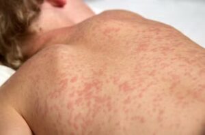 Estado de São Paulo confirma primeiro caso de sarampo em 2026